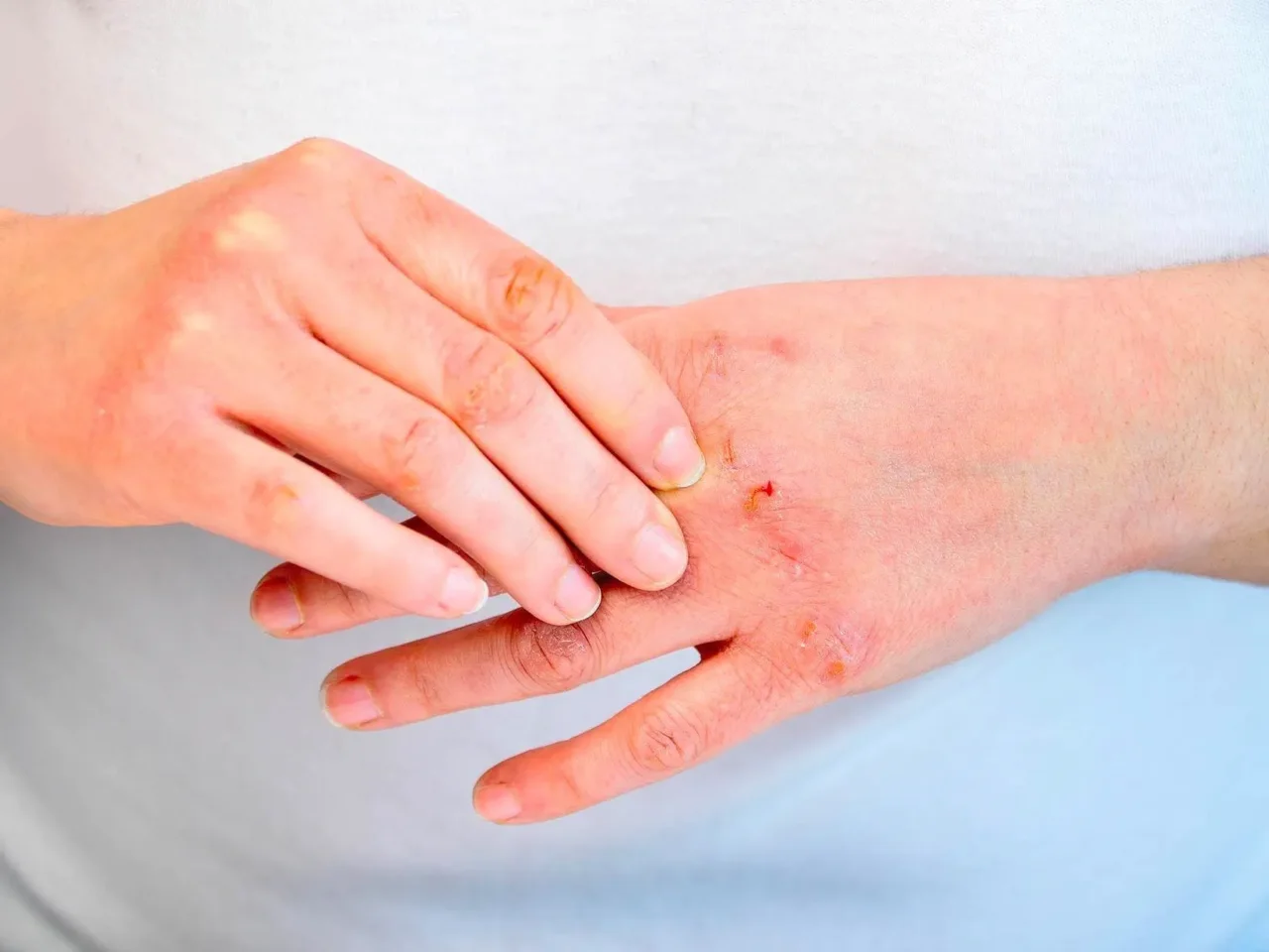 Usi la comune soluzione disinfettante per le ferite? Ecco l’errore che fa male alla pelle